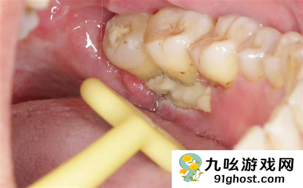 这件多数人不重视的小事 关键时刻可能把癌症治疗拖垮