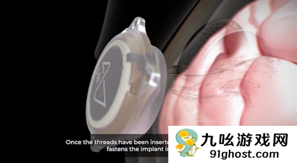 1.5秒植入！马斯克脑机接口公司技术新突破 超万人等待上脑